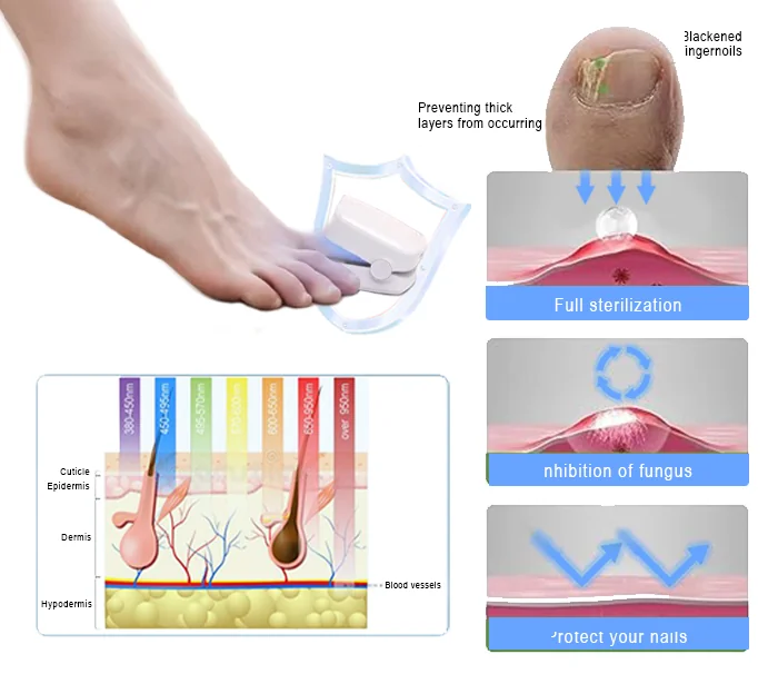 Suptruck Revolutionary HighEfficiency Light Therapy Device For Toenail